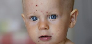 CHICKENPOX  Chickenpox on a 1-year-old child (5th day).  GIRAND / BSIP